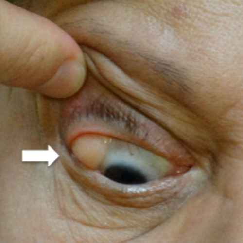 Optic Nerve Conditions